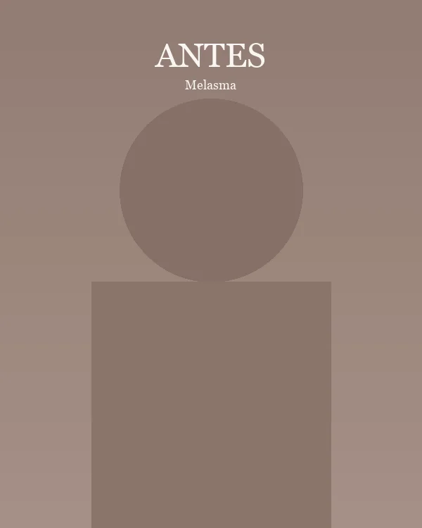 Antes tratamento melasma